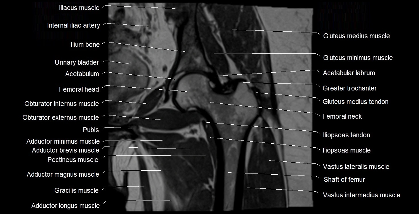 MRI Hip 3T coronal cross sectional anatomy image 33.webp